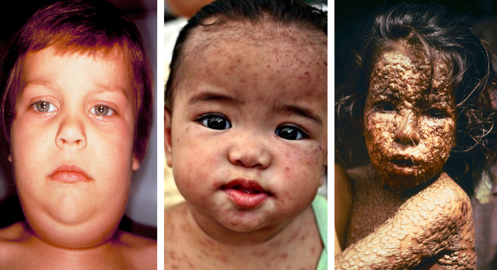 images of mumps, measles and smallpox in children mms